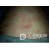小孩子出现过敏的原因、