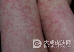 面部皮肤有过敏的病症