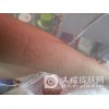 夏季防治皮炎有什么需要注意的问题
