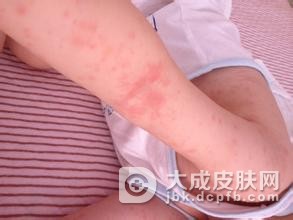 夏季多发的日光性皮炎是什么样的