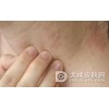 夏季皮炎有什么防治措施呢