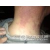 夏季预防过敏性皮炎早下手