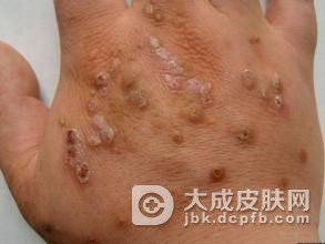 急性湿疹与慢性湿疹都有哪些特征