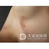影响复发性慢性湿疹的现代工业因素有什么