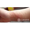 慢性湿疹是怎么病发的