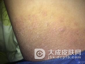 慢性湿疹患者的家庭保健法