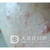 化妆品过敏性皮炎怎么办