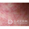 化妆品皮炎诱因有哪些