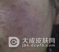 化妆品皮炎的预防方法都有哪些呢