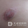 女性乳房湿疹注意什么