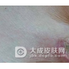乳房湿疹的发病原因是什么