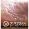 夏季如何预防脚癣