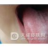 中医治疗皱襞舌的方法是什么