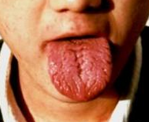 皱襞舌的主要特点是什么