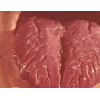 皱襞舌容易与哪些病混淆