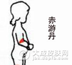 复发性赤游丹患者如何诊断