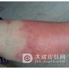 赤游丹不是病毒感染引起