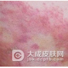 赤游丹是如何发病并传染的