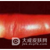 赤游丹患者注意休息好