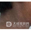 里尔黑变病好发于哪些部位