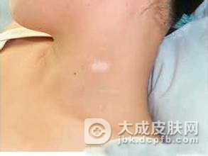 诱发白癜风的三大因素