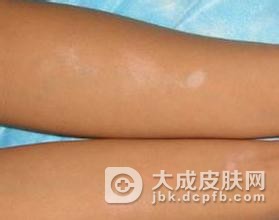 儿童白癜风有什么症状特点