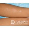 儿童白癜风有什么症状特点