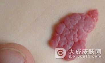 血管瘤早期有哪些症状表现