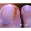 甲沟炎的健康保健常识