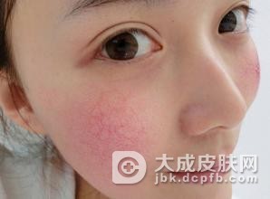 如何诊断红血丝的症状