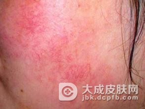 夏季红血丝预防