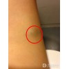 皮下脂肪瘤的原因是什么