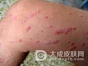 银屑病病因的几点诱发因素