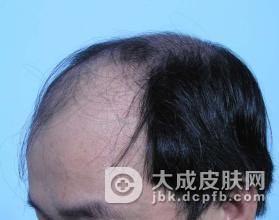 脂溢性脱发的症状都有哪些呢？