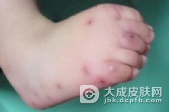 小儿丘疹性肢端皮炎的症状是什么