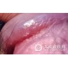 你了解女性尖锐湿疣吗