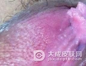 女性如何预防阴道尖锐湿疣的发生呢