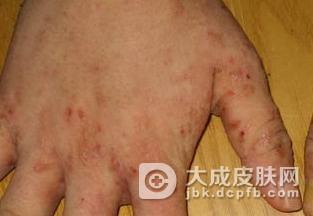 疥疮治疗起来是不是不那么容易呢