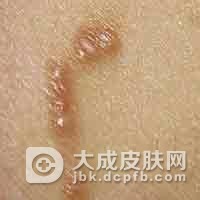 疥疮的发病给患者带来哪些压力和烦恼