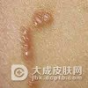 疥疮的发病给患者带来哪些压力和烦恼