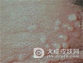 生殖器疱疹感染的具体原因有哪些