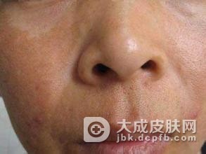 形成黄褐斑的原因有哪些呢