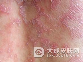 是什么原因引起了玫瑰糠疹发作