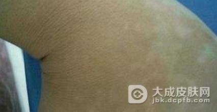 儿童白癜风诊断的依据有哪些?