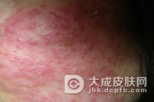 过敏性皮炎吃什么对病情好