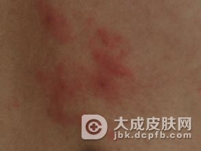 儿童过敏性皮炎护理方法有哪些