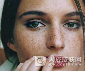 雀斑发病有什么特点