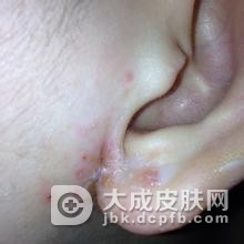 冬天冻疮是怎样构成的