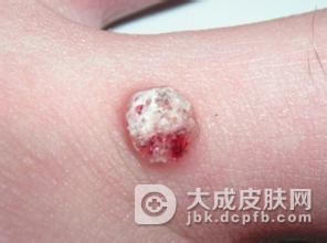寻常疣疾病要怎样进行保养