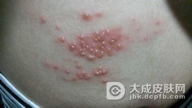 如何预防儿童带状疱疹